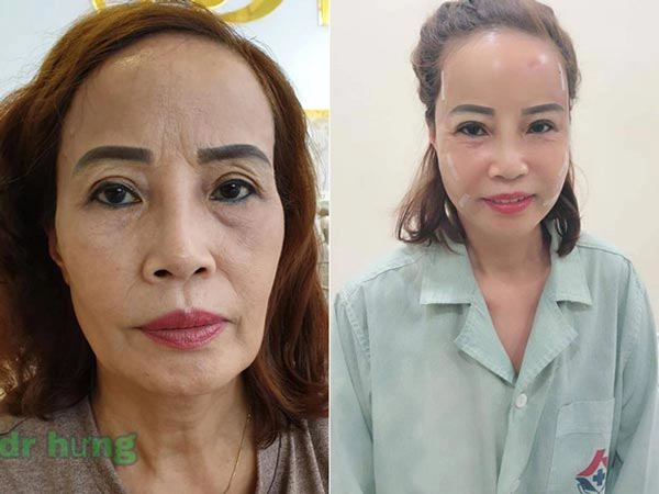 Phẫu thuật thẩm mỹ hết mặt cô dâu 62 tuổi vẫn bị da nhăn nheo chảy xệ - 2
