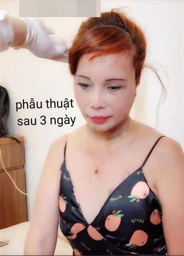 Phẫu thuật thẩm mỹ hết mặt cô dâu 62 tuổi vẫn bị da nhăn nheo chảy xệ - 5
