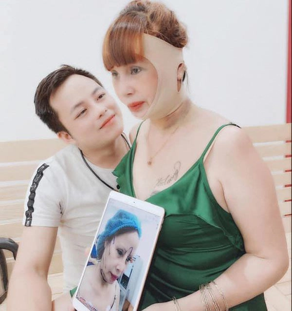 Phẫu thuật thẩm mỹ hết mặt cô dâu 62 tuổi vẫn bị da nhăn nheo chảy xệ - 6