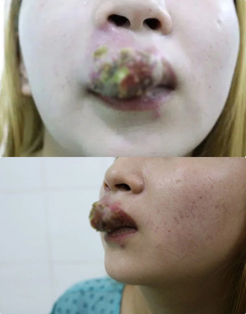 Đua nhau làm đẹp đón tết người suýt mù mắt vì tiêm filler người môi mưng mủ vì xăm - 1