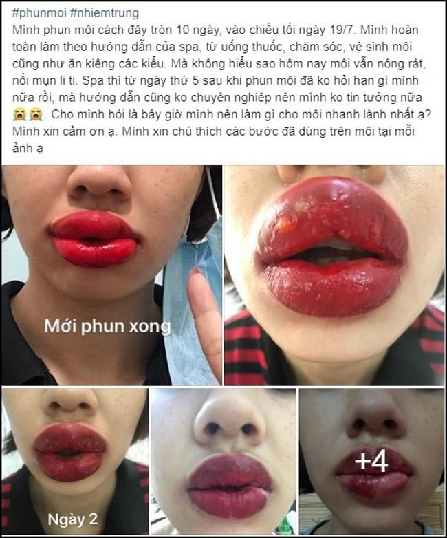 Đua nhau làm đẹp đón tết người suýt mù mắt vì tiêm filler người môi mưng mủ vì xăm - 3
