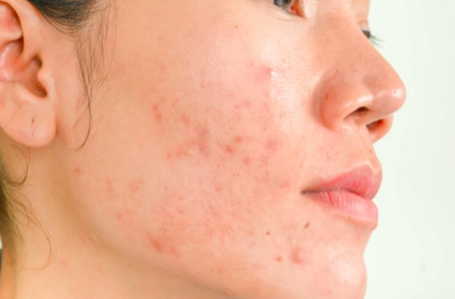 Dùng bha chống lão hoá nhưng bị bùng mụn viêm và mụn bọc là do thiếu đồ chơi đi kèm - 1