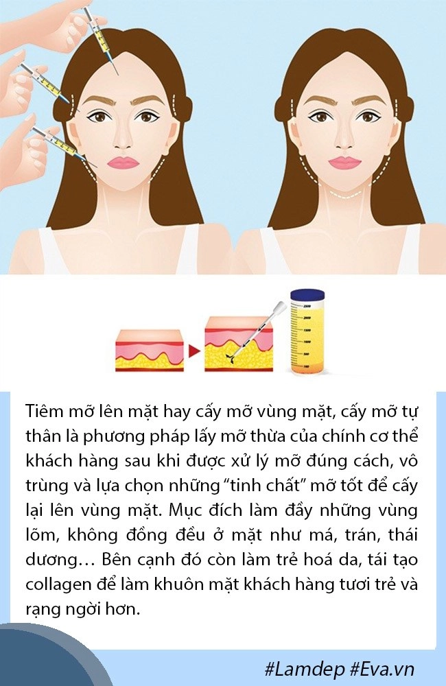 Giải đáp thắc mắc về cấy mỡ tự thân lấy mỡ vùng nào giữ lâu nhất filler liệu có cửa - 2