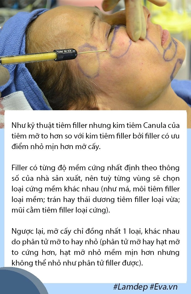 Giải đáp thắc mắc về cấy mỡ tự thân lấy mỡ vùng nào giữ lâu nhất filler liệu có cửa - 3