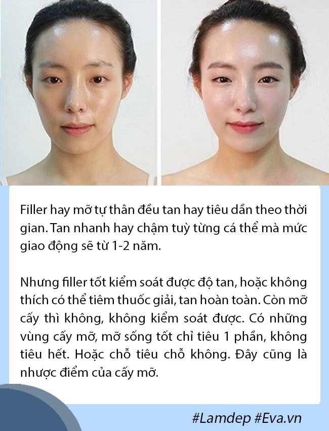 Giải đáp thắc mắc về cấy mỡ tự thân lấy mỡ vùng nào giữ lâu nhất filler liệu có cửa - 4