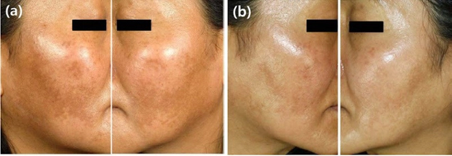 Giải mã pharmaform skin brightener - serum trắng da giảm thâm nám chỉ sau 4 tuần - 2