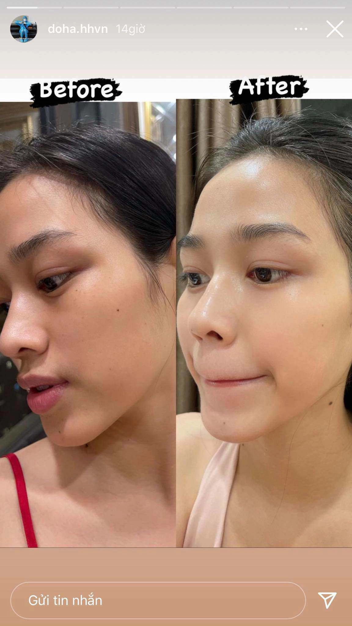 Hà hồ tự làm chuột bạch thử nghiệm mỹ phẩm da bong tróc hỏng luôn mặt tiền - 9
