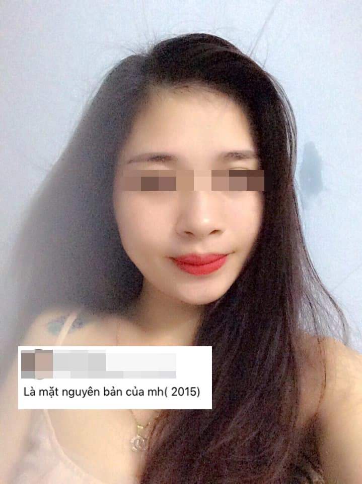 Hành trình làm đẹp 5 năm xót ví của mẹ 2 con thủng mũi áp-xe má đau nhất chữa nám - 2
