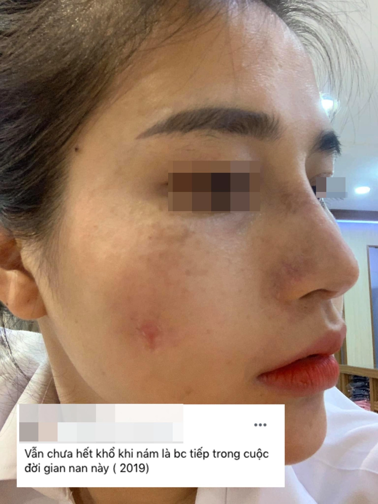Hành trình làm đẹp 5 năm xót ví của mẹ 2 con thủng mũi áp-xe má đau nhất chữa nám - 7