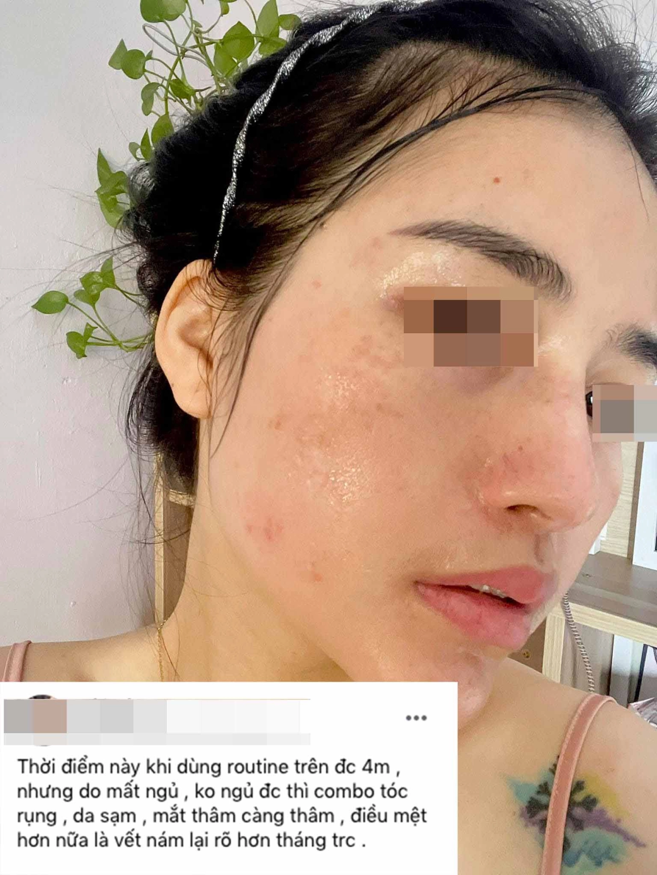Hành trình làm đẹp 5 năm xót ví của mẹ 2 con thủng mũi áp-xe má đau nhất chữa nám - 10