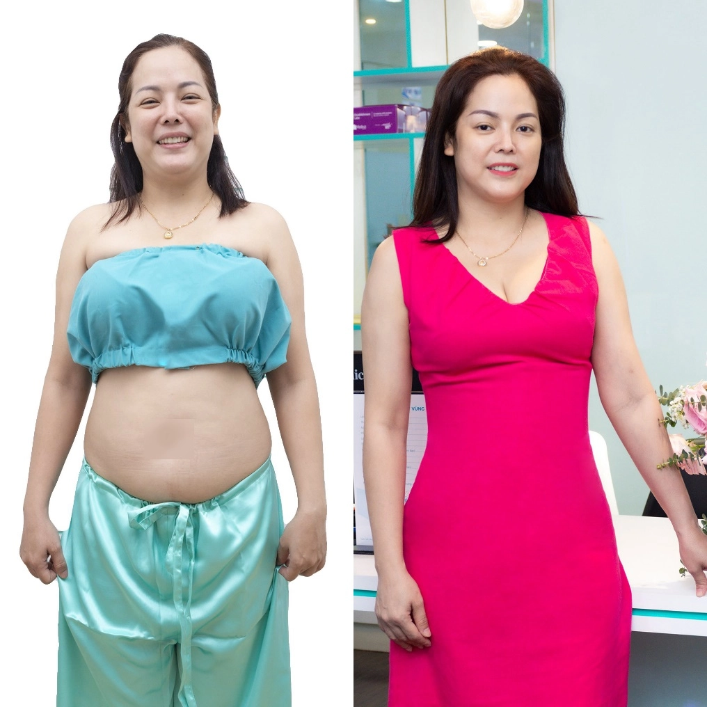 Hành trình u45 thay đổi vóc dáng nhờ hút mỡ lipo pal-extra - 1