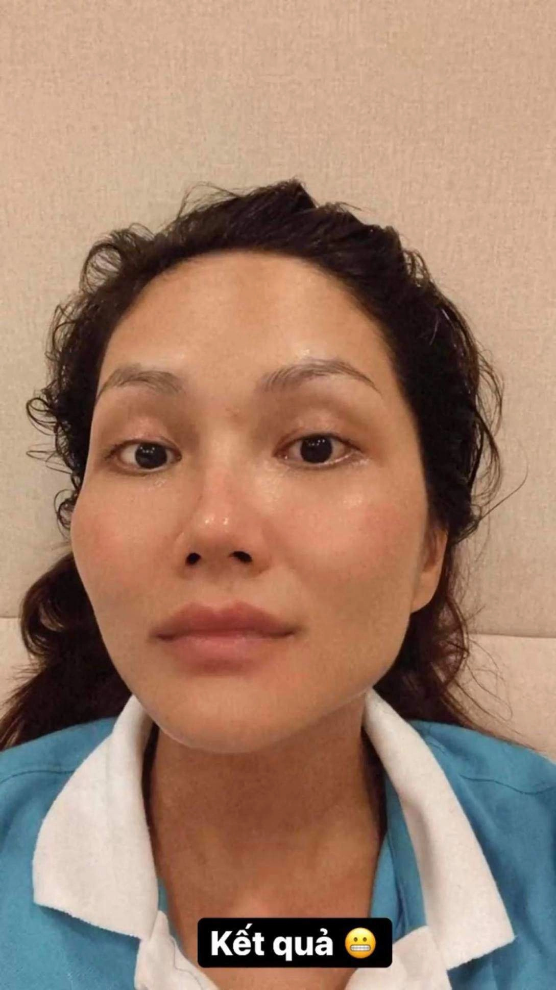 Hhen niê xuất hiện với gương mặt bầm dập skincare kiểu gì mà hỏng luôn mặt tiền - 2