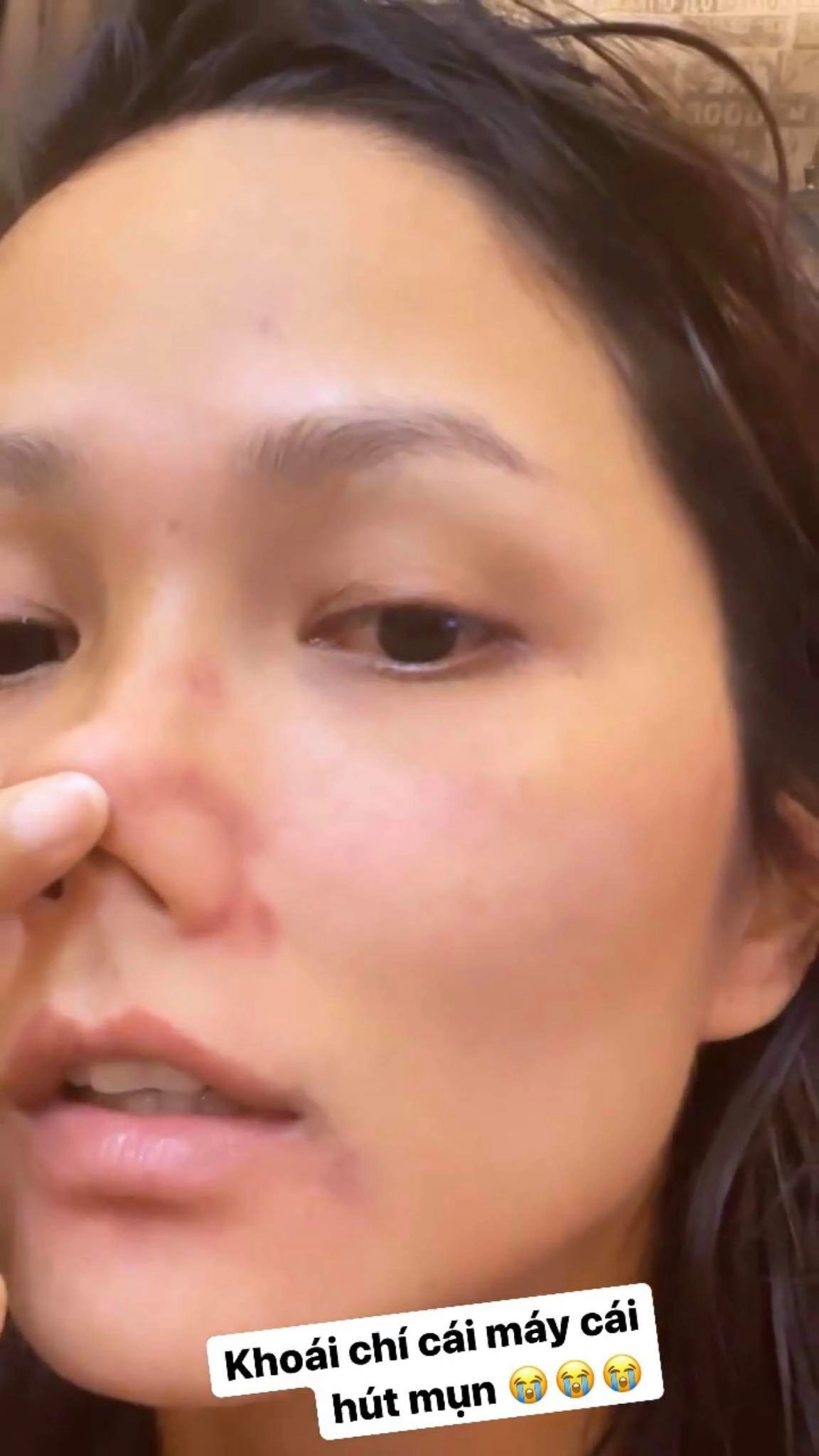 Hhen niê xuất hiện với gương mặt bầm dập skincare kiểu gì mà hỏng luôn mặt tiền - 3