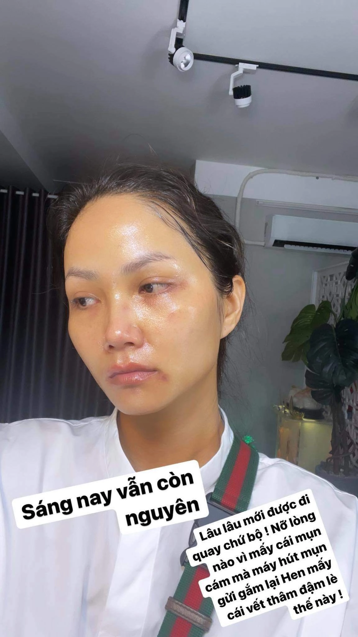 Hhen niê xuất hiện với gương mặt bầm dập skincare kiểu gì mà hỏng luôn mặt tiền - 4