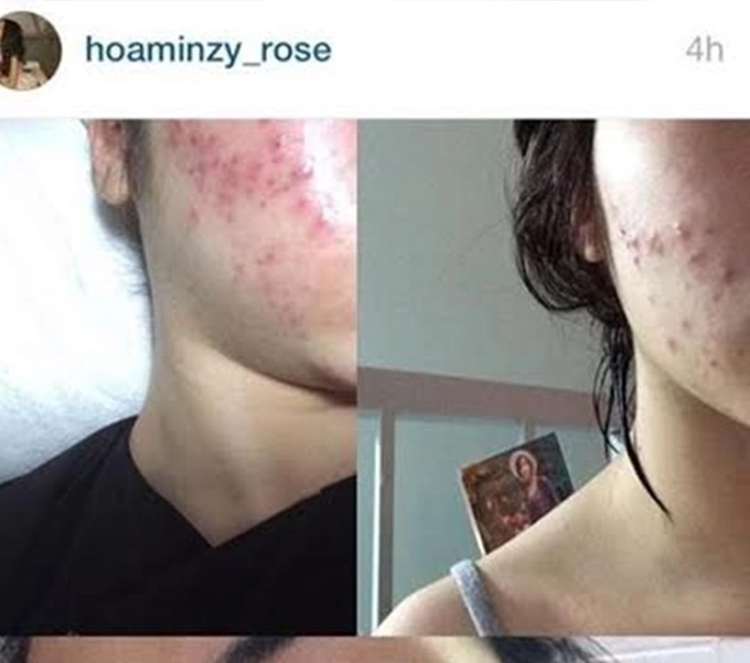 Hòa minzy mỗi lần skincare hơn 1 tiếng thanh lý cả rổ mụn nhờ chú trọng bước làm sạch - 2