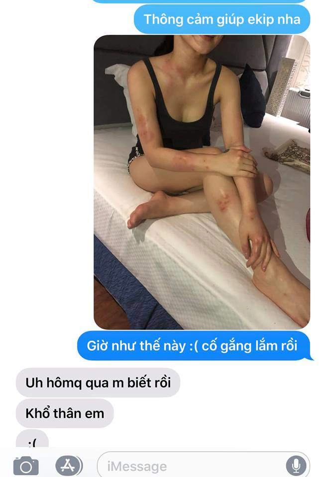 Hoảng hốt trước làn da nổi đầy mụn đỏ và ngứa vì bị dị ứng cấp tính của hương tràm - 1