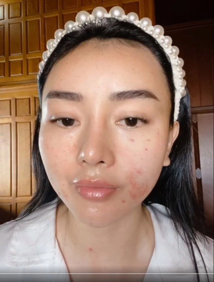 Hotgirl miền tây lấy tỷ phú thái đi nâng cơ mặt nhận về cái kết kích ứng bỏng da - 5