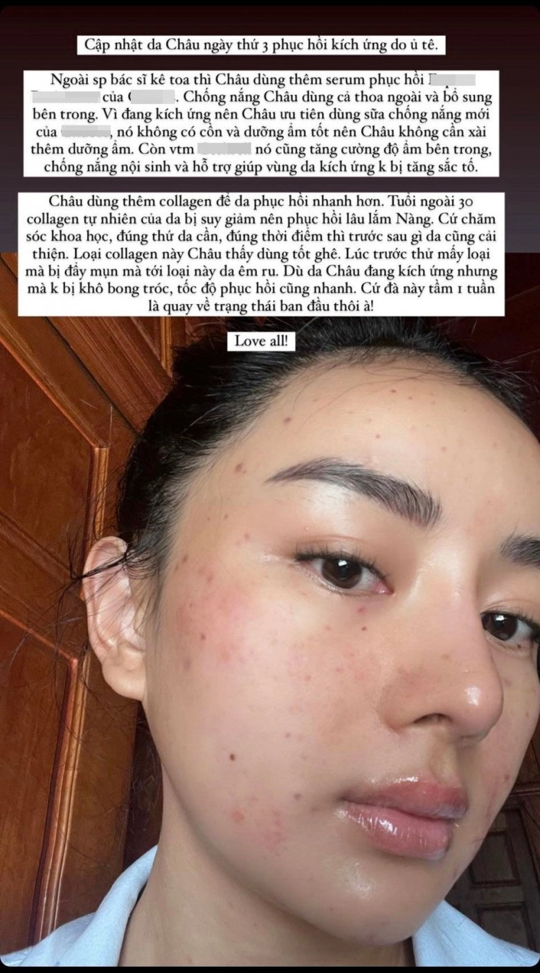 Hotgirl miền tây lấy tỷ phú thái đi nâng cơ mặt nhận về cái kết kích ứng bỏng da - 6