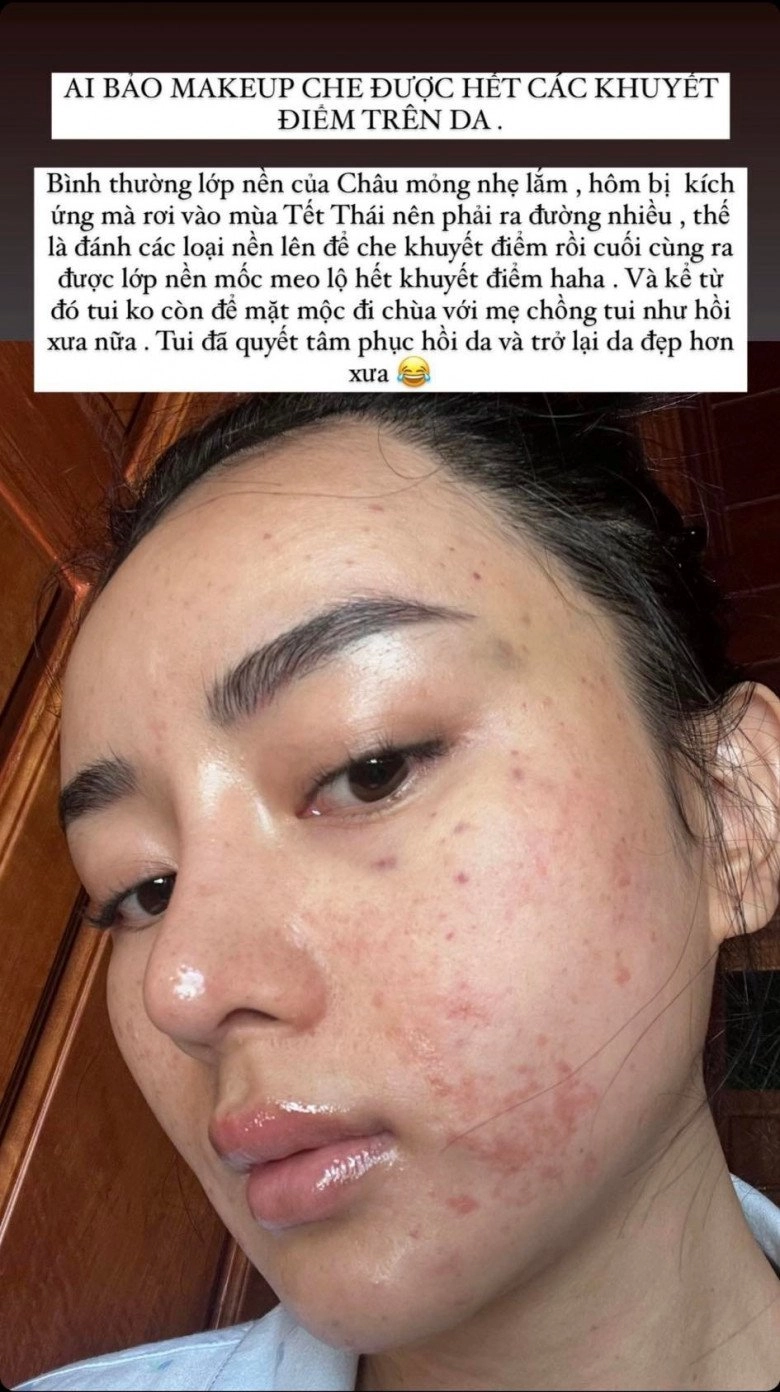 Hotgirl miền tây lấy tỷ phú thái đi nâng cơ mặt nhận về cái kết kích ứng bỏng da - 7