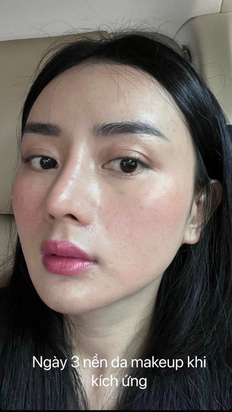 Hotgirl miền tây lấy tỷ phú thái đi nâng cơ mặt nhận về cái kết kích ứng bỏng da - 9