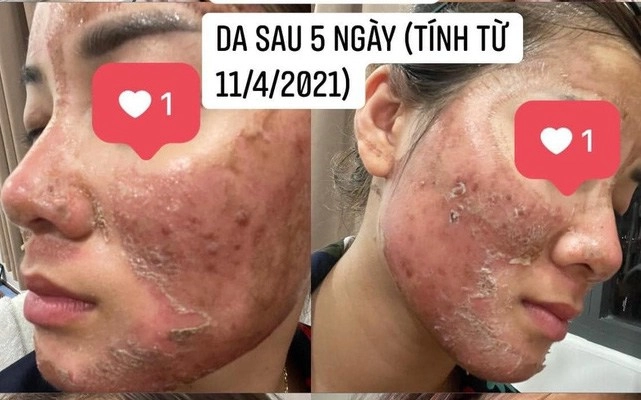 Hotgirl tự peel da tại nhà da bong mảng như rắn lột đẹp thì ít hại thì nhiều - 8