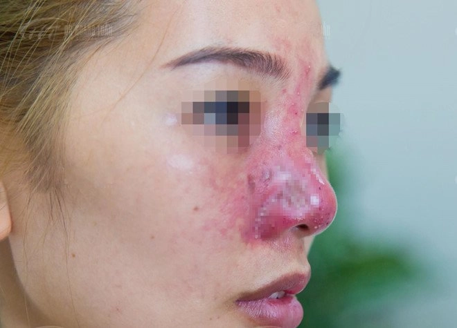 Huyền baby tiêm filler lên mũi cằm thon gọn hàm để trở nên hoàn mỹ - 17