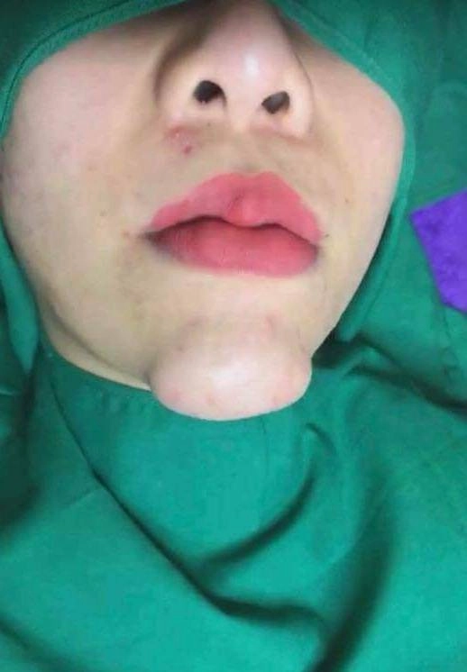 Huyền baby tiêm filler lên mũi cằm thon gọn hàm để trở nên hoàn mỹ - 18