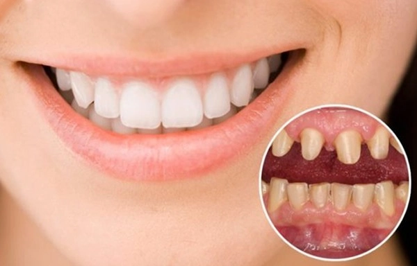 Làng nhan sắc xém nữa đã có 1 vụ kiện giữa hai mỹ nhân chỉ vì chuyện làm răng sứ - 18