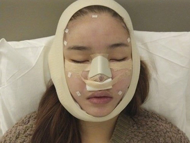 Liên tục lộ mũi biến dạng danh hiệu nam thần màn ảnh vbiz của việt anh nay còn đâu - 10
