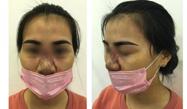 Mắc phải những sai lầm tai hại này khi tiêm filler chị em có thể phá huỷ cả gương mặt - 3