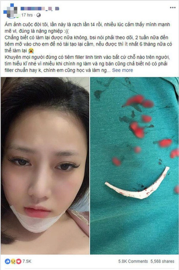 Mắc phải những sai lầm tai hại này khi tiêm filler chị em có thể phá huỷ cả gương mặt - 4