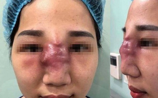 Mắc phải những sai lầm tai hại này khi tiêm filler chị em có thể phá huỷ cả gương mặt - 7