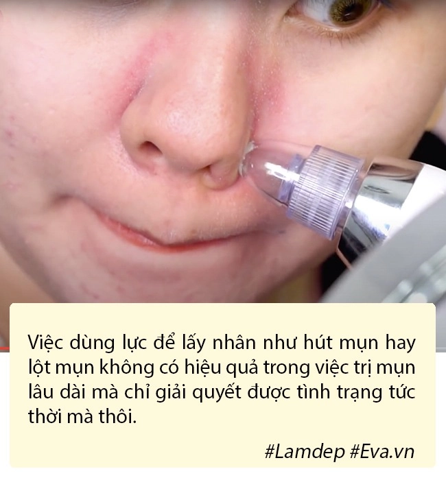 Máy hút mụn đầu đen lợi hại thật nhưng đây có phải cách trị mụn bạn nên dùng - 3