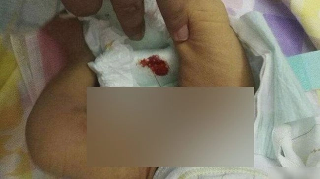 Mẹ bỉm sữa lo lắng khi con 3 tuần tuổi đã rụng dâu đỏ hết cả bỉm - 2