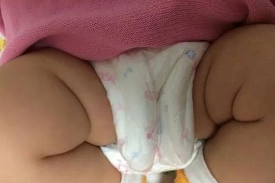 Mẹ phát hiện ngấn 2 bên chân con không đối xứng bs kết luận chữa nhanh còn kịp - 1