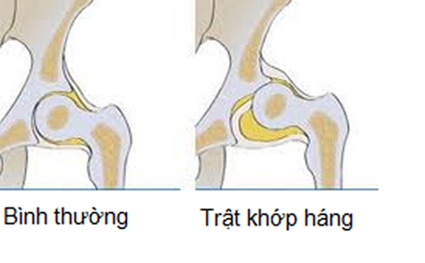 Mẹ phát hiện ngấn 2 bên chân con không đối xứng bs kết luận chữa nhanh còn kịp - 3