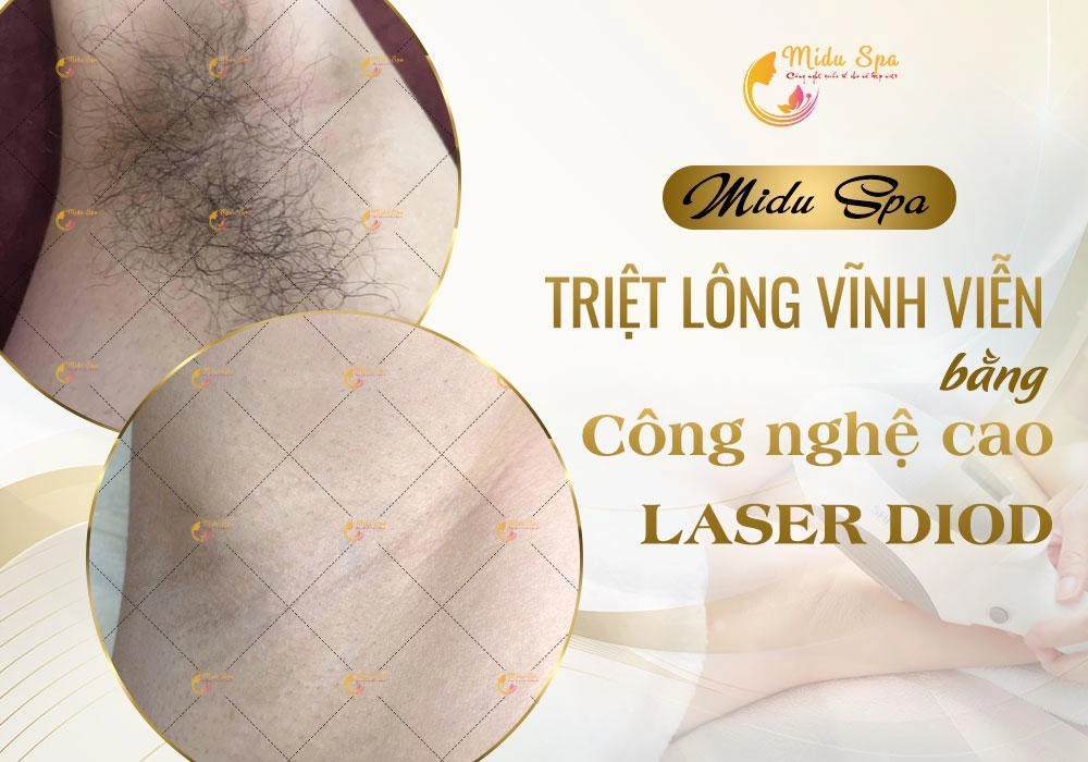 Midu spa trung tâm chuyên triệt lông hiệu quả tại tphcm - 1