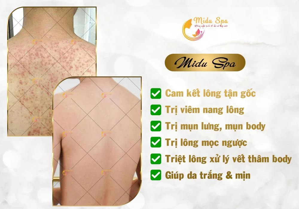 Midu spa trung tâm chuyên triệt lông hiệu quả tại tphcm - 2