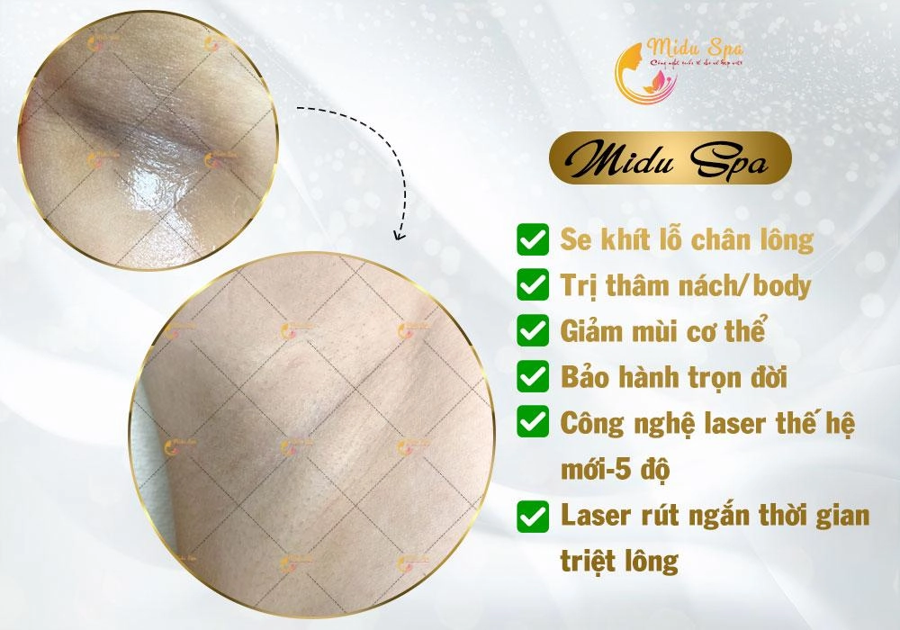 Midu spa trung tâm chuyên triệt lông hiệu quả tại tphcm - 3