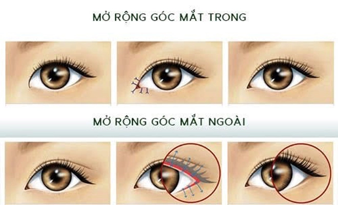 Mở góc mắt là gì mà được nhiều chị em quan tâm - 1