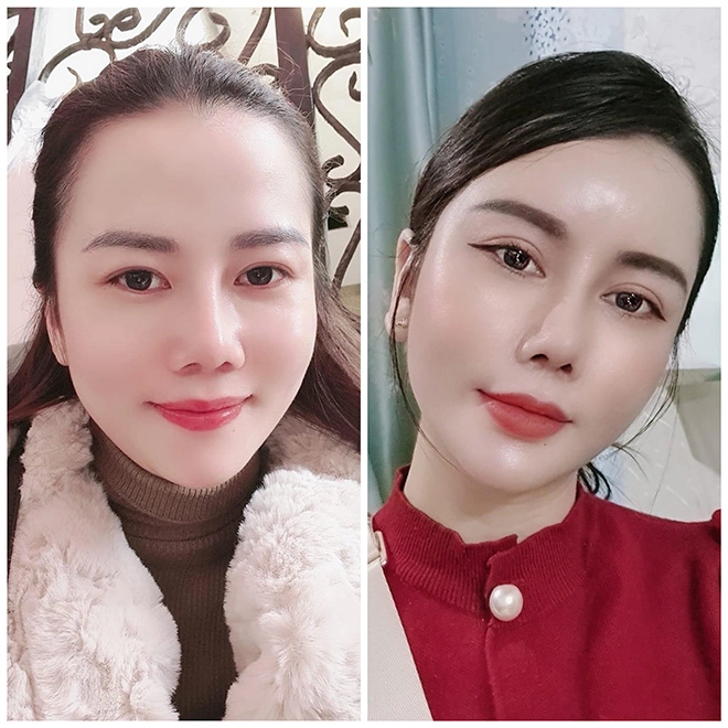 Mở góc mắt là gì mà được nhiều chị em quan tâm - 3