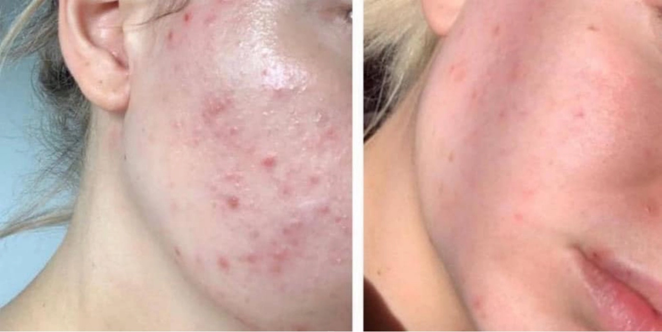 Mùa hè mặt như chảo dầu chiên cá nàng nhất định phải để ý những thành phần này trong serum - 5