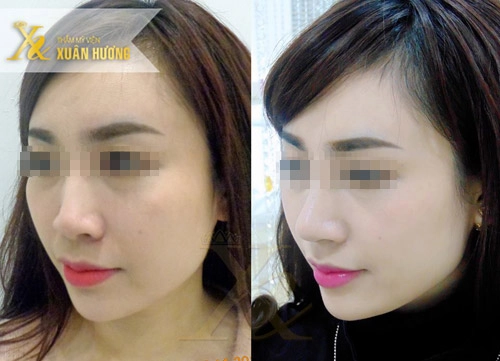 Mũi cao có phải là mũi đẹp - 3
