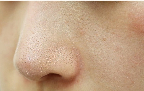 Mụn cám là gì nguyên nhân hình thành và cách chăm sóc như thế nào - 1