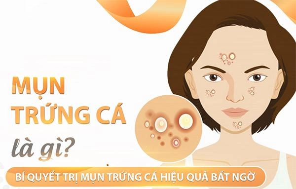 Mụn trứng cá xuất hiện do đâu và cách điều trị hiệu quả - 1