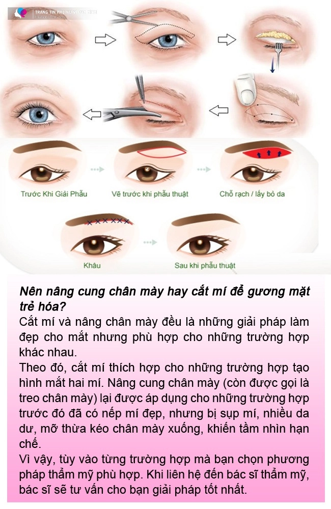 Nâng cung chân mày chống lão hóa quý cô trung niên nhận về đường rạch ngang tới thái dương - 9