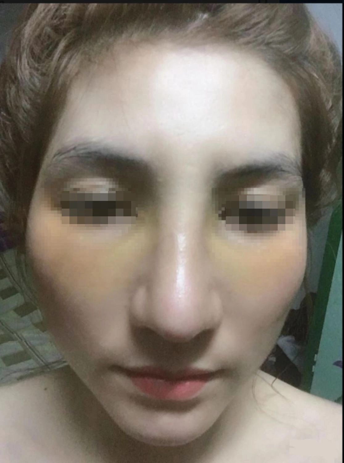 Nâng mũi như cuộc chạy đua với thời trang làm đủ kiểu cuối cùng vẫn quay về 1 dáng - 3