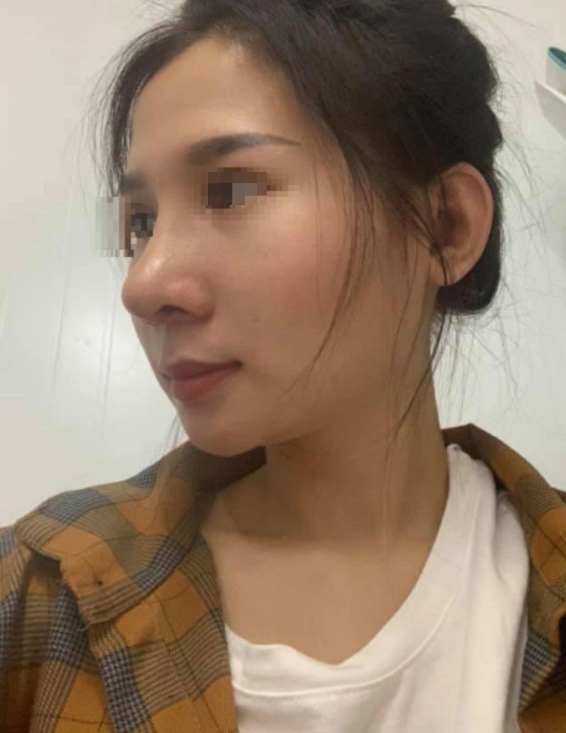 Nâng mũi như cuộc chạy đua với thời trang làm đủ kiểu cuối cùng vẫn quay về 1 dáng - 4