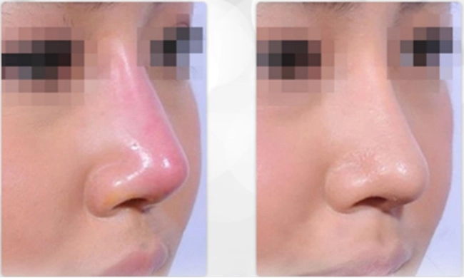 Nâng mũi như cuộc chạy đua với thời trang làm đủ kiểu cuối cùng vẫn quay về 1 dáng - 5