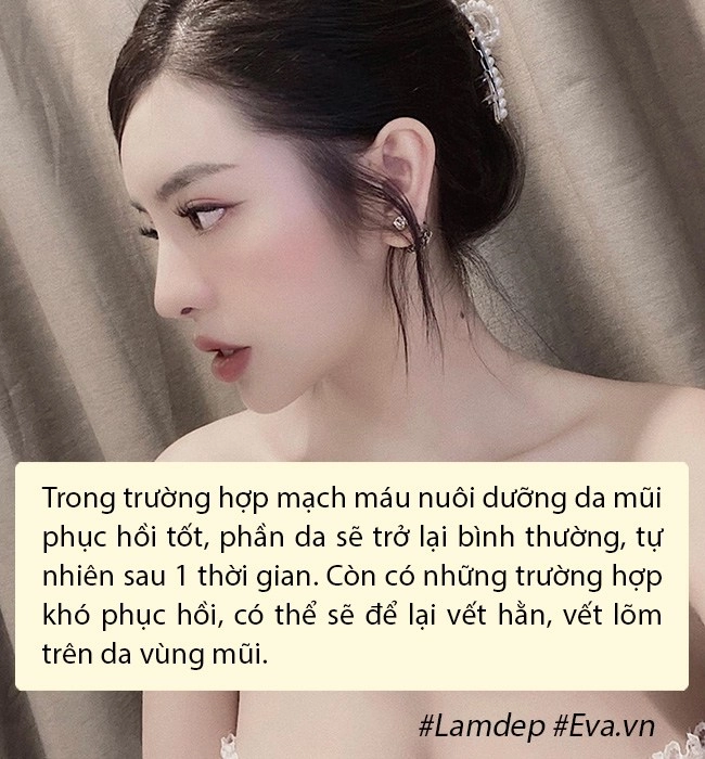 Nâng mũi như cuộc chạy đua với thời trang làm đủ kiểu cuối cùng vẫn quay về 1 dáng - 9